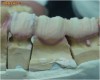 Vand Licenta tehnica dentara cu tema: Reabilitari protetice prin protezari conjuncte mixte metalo- ceramice